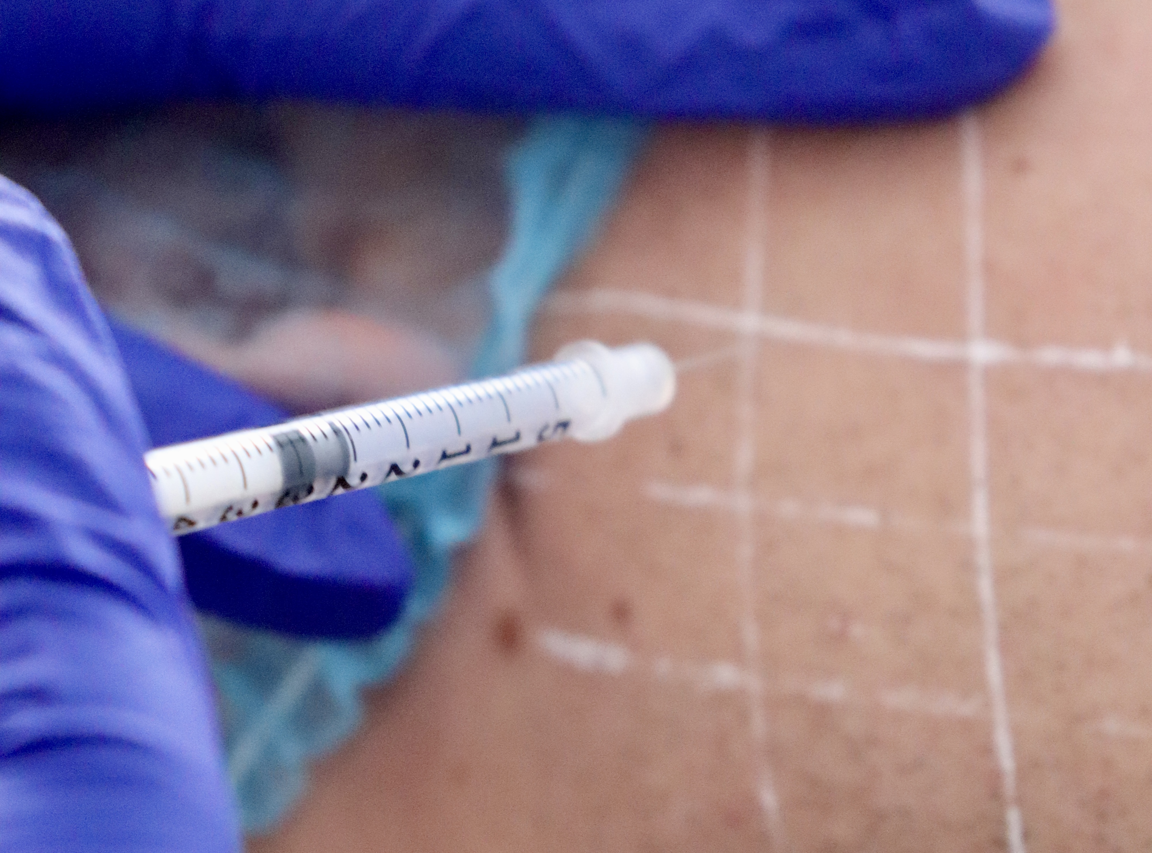 Botulinum-Toxin Injektion